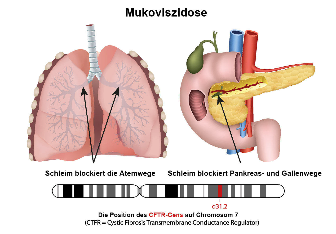 gip-haeusliche-intensivpflege-mukoviszidose-Bild-1er
